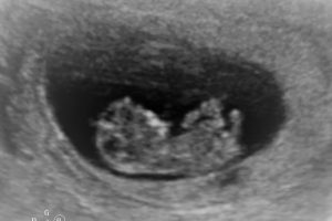zwanger 12 weken echo Ikverwacht tweede kindje